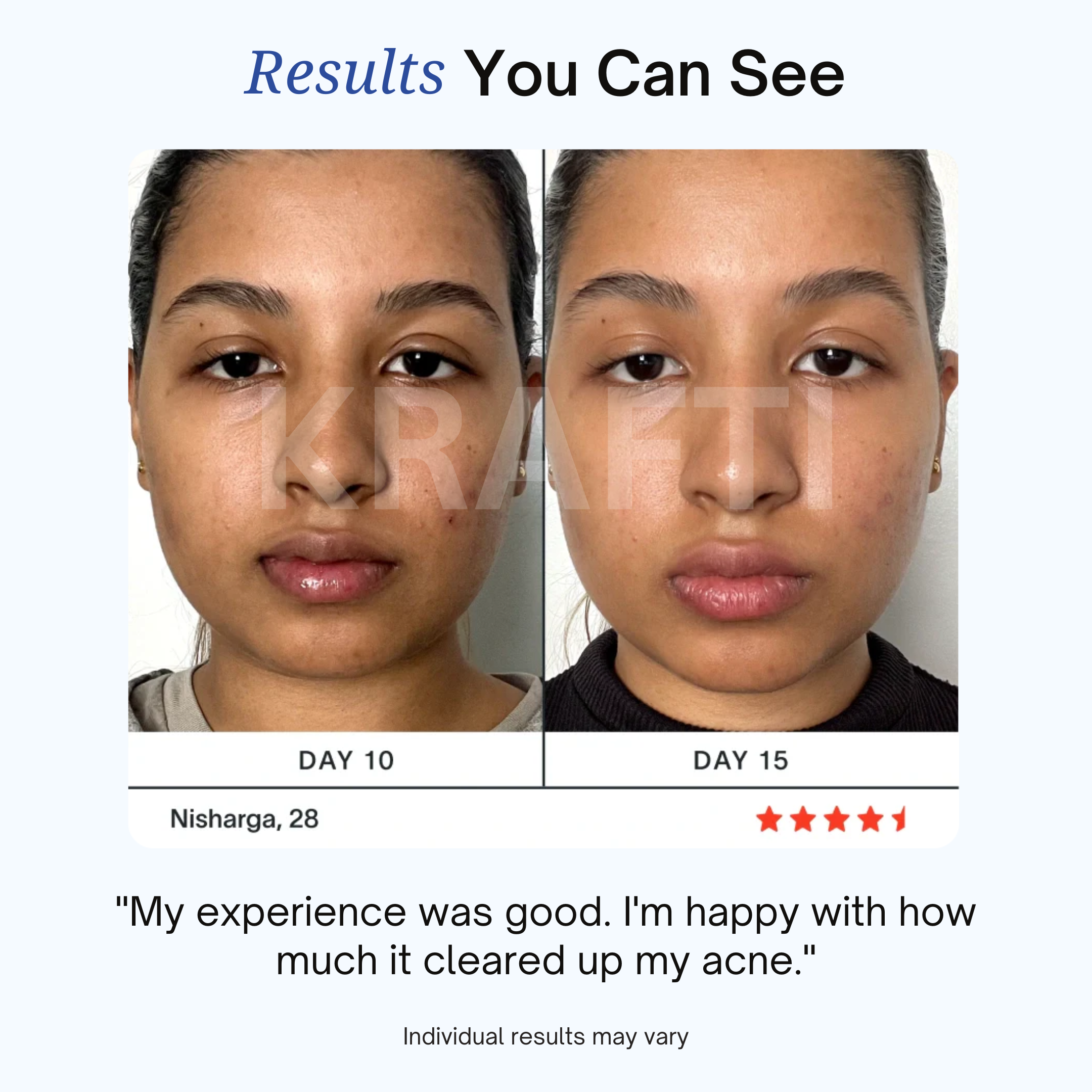 KRAFTI 3-Minute Pimple Spot Treatment