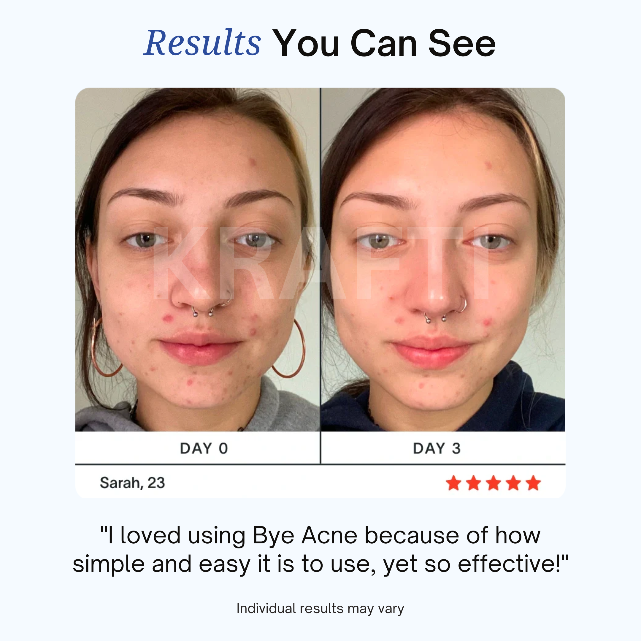 KRAFTI 3-Minute Pimple Spot Treatment